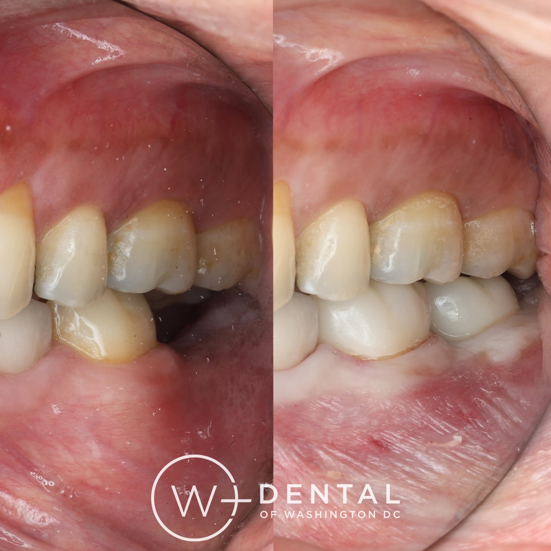 before and after dental bonding for a chipped tooth