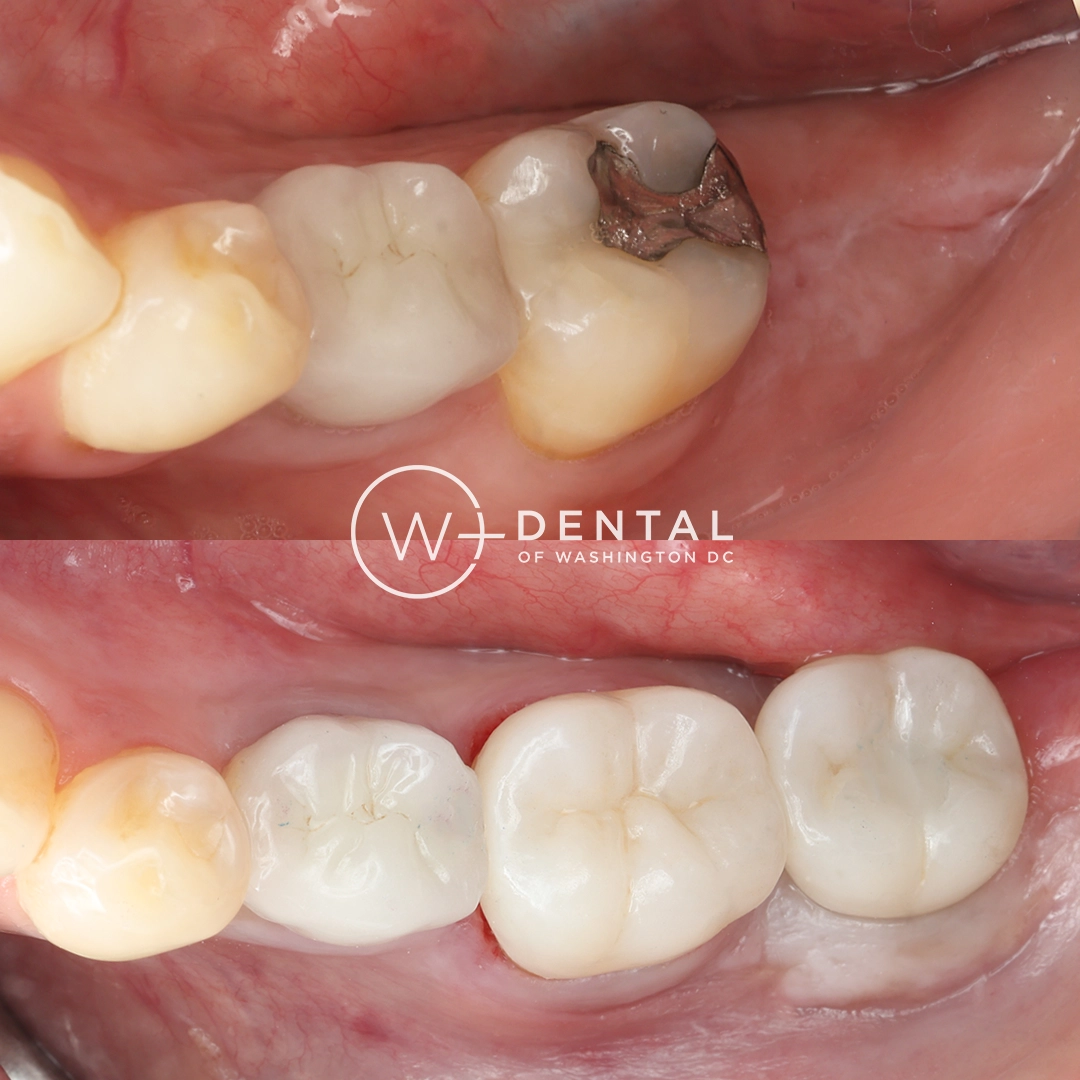 before and after dental bonding for a chipped tooth