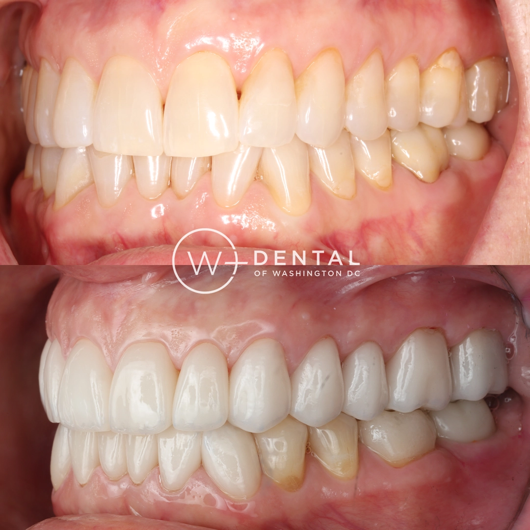 before and after dental bonding for a chipped tooth