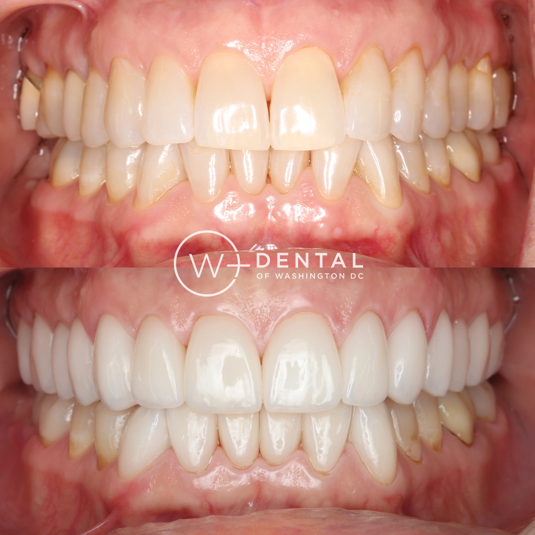 before and after dental bonding for a chipped tooth