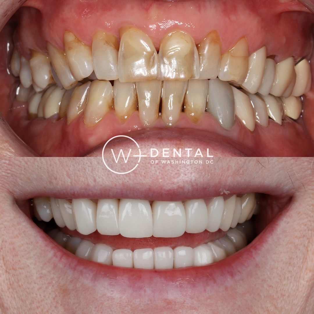 before and after dental bonding for a chipped tooth