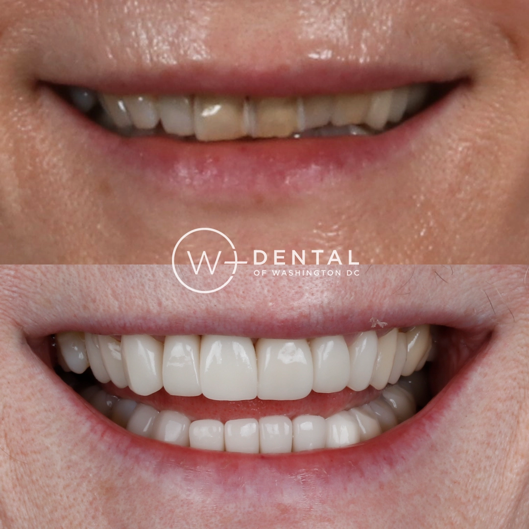 before and after dental bonding for a chipped tooth