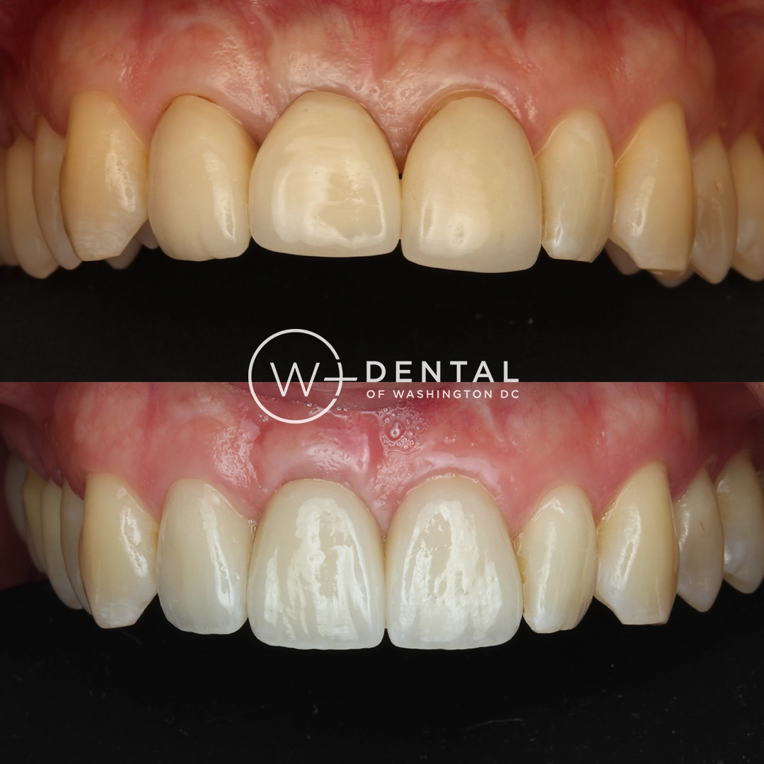 before and after dental bonding for a chipped tooth