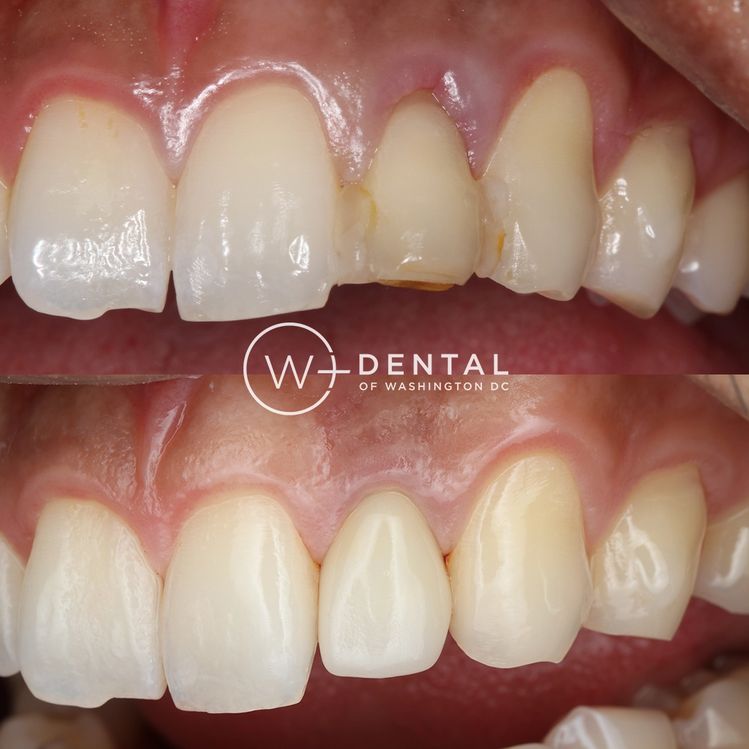 before and after dental bonding for a chipped tooth