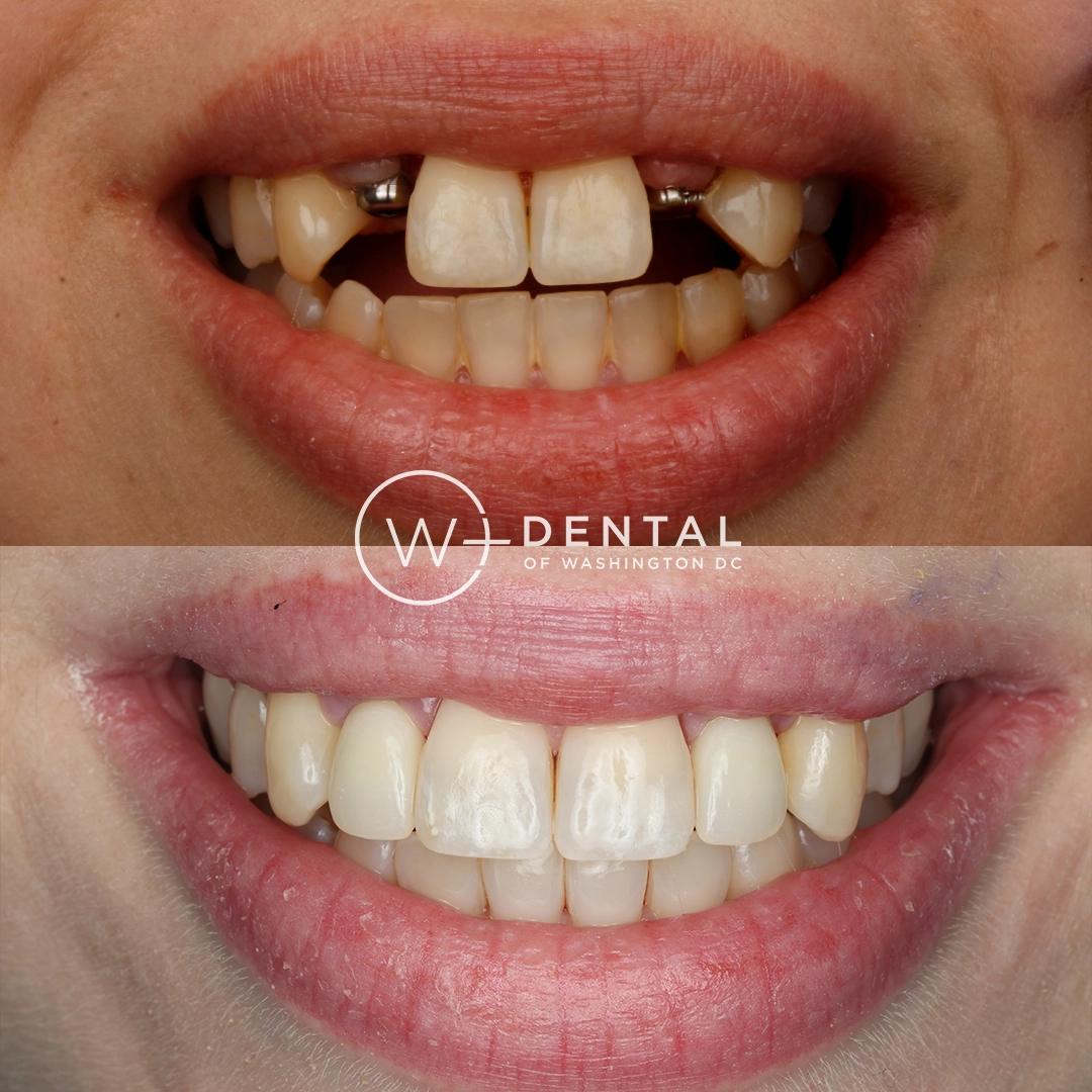 before and after dental bonding for a chipped tooth