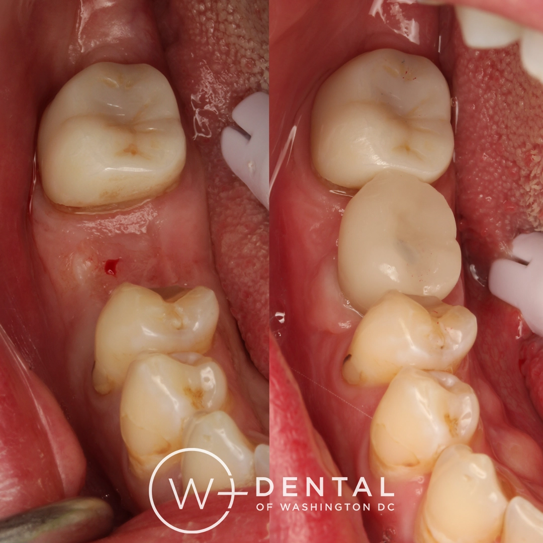 before and after dental bonding for a chipped tooth