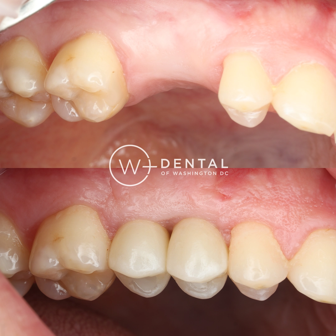 before and after dental bonding for a chipped tooth