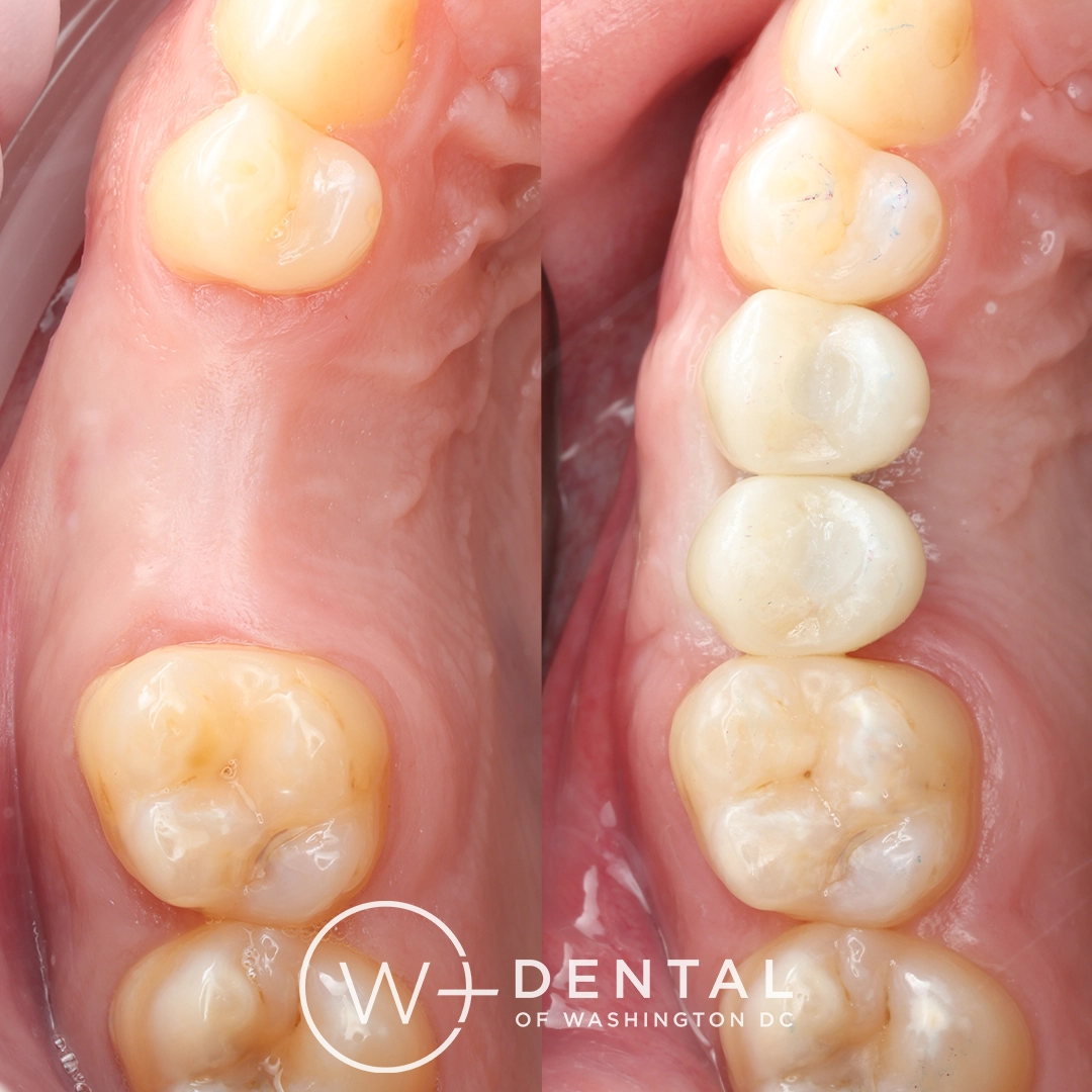 before and after dental bonding for a chipped tooth