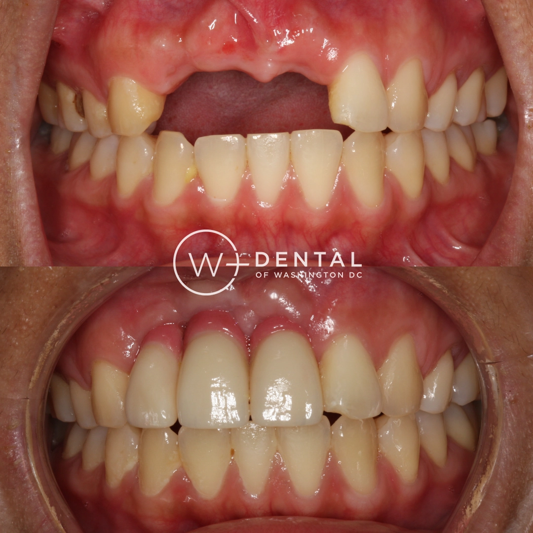 before and after dental bonding for a chipped tooth
