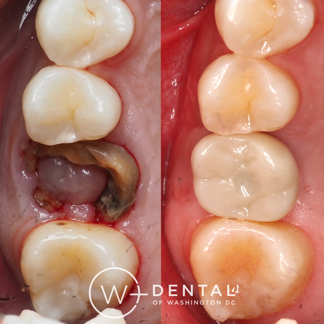before and after dental bonding for a chipped tooth