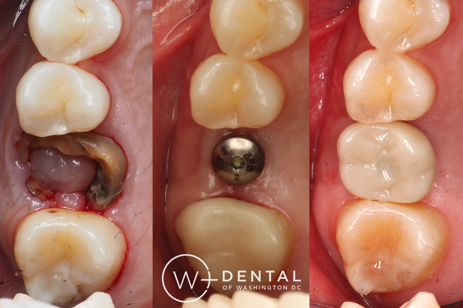 before and after dental bonding for a chipped tooth