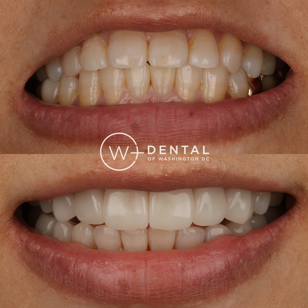 before and after dental bonding for a chipped tooth