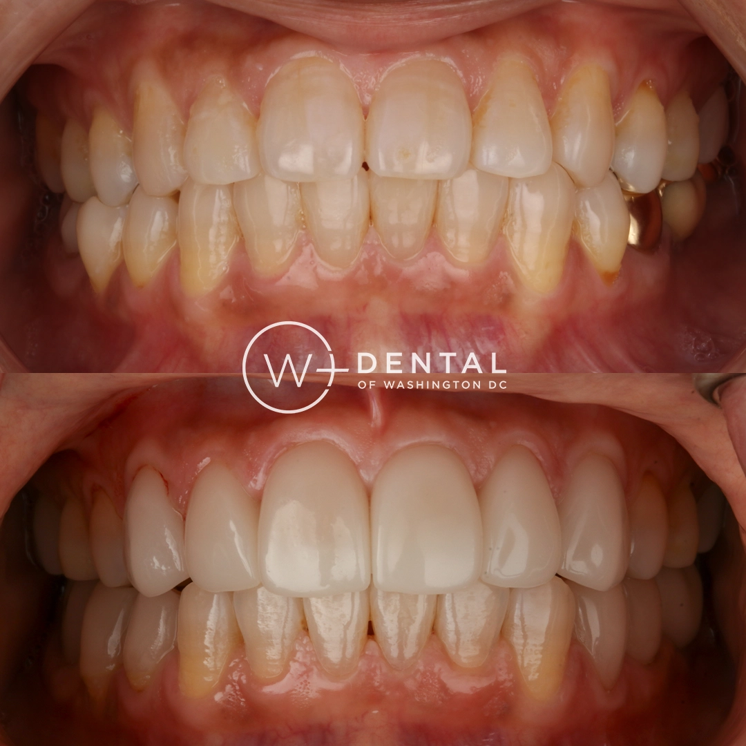 before and after dental bonding for a chipped tooth