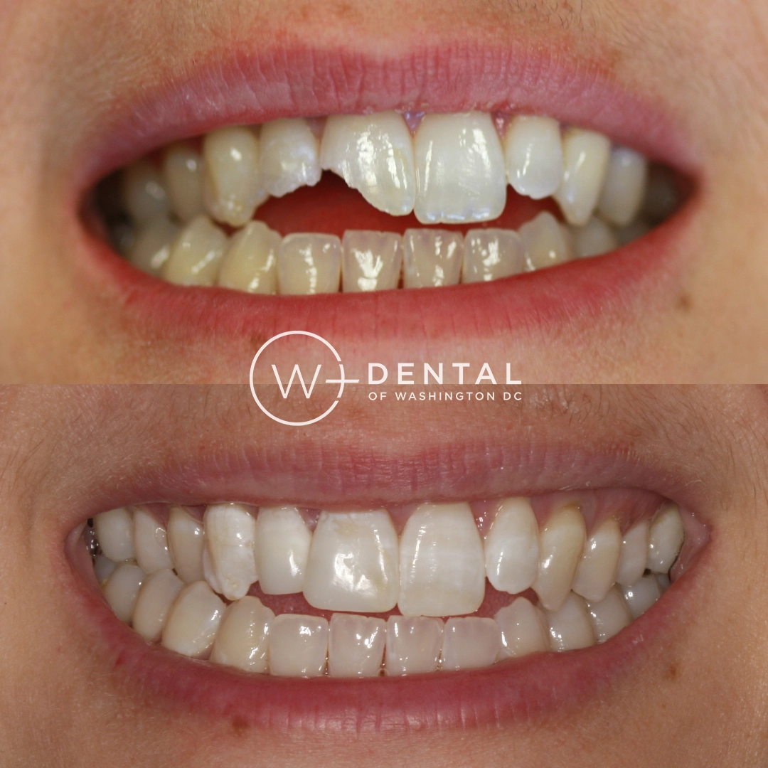 before and after dental bonding for a chipped tooth