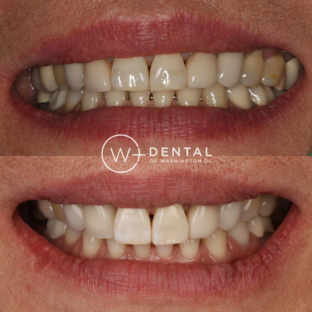 before and after dental bonding for a chipped tooth