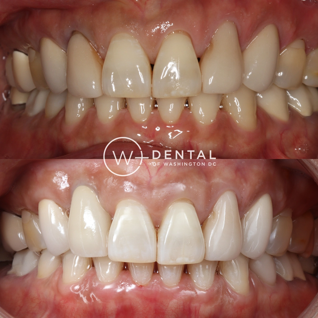Before and after smile makeover with dental crowns at W Plus Dental – full smile restoration correcting damaged, worn, and discolored teeth, Washington DC