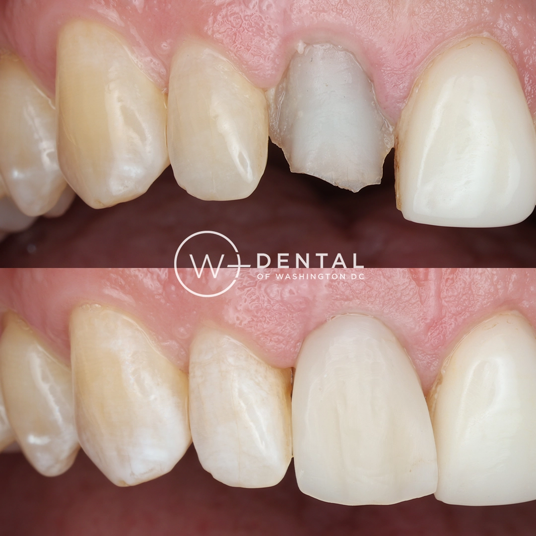Before and after dental implants at W Plus Dental – patient's smile transformation showing missing teeth replaced with natural-looking implants and custom crowns, Washington DC