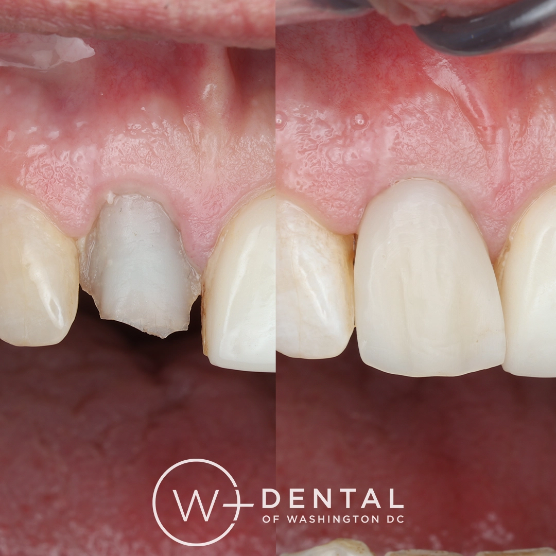 before and after dental bonding for a chipped tooth
