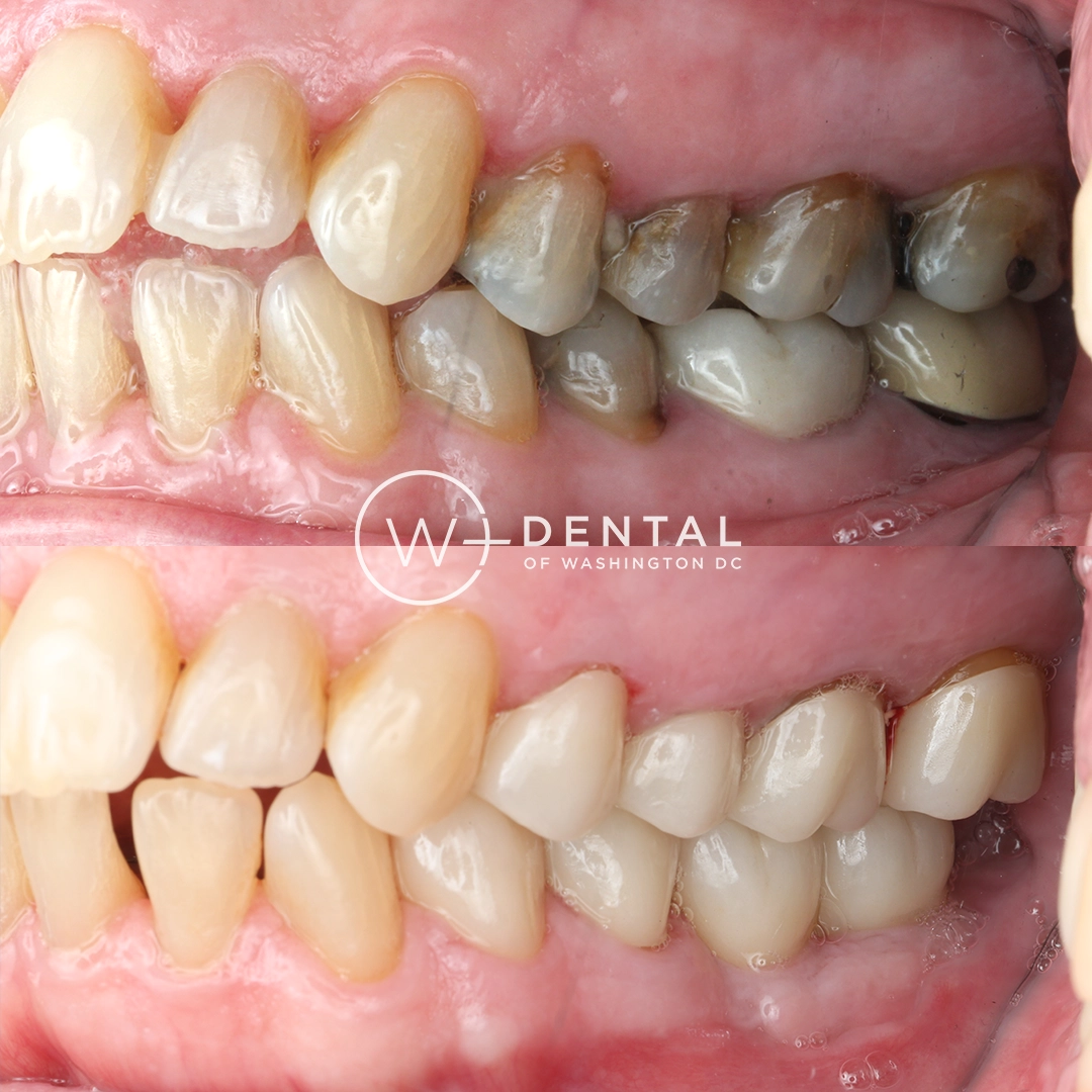 before and after dental bonding for a chipped tooth