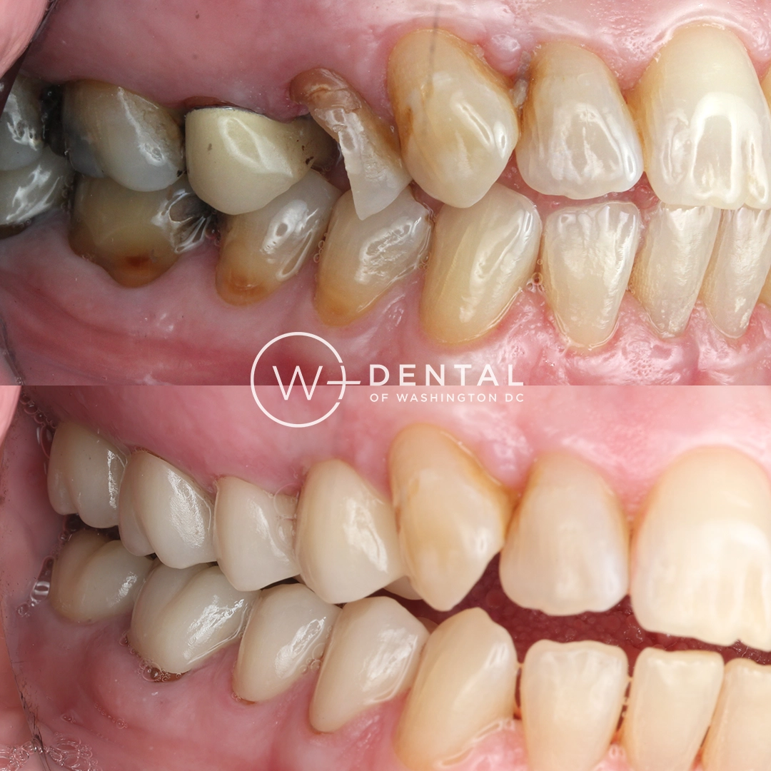 before and after dental bonding for a chipped tooth