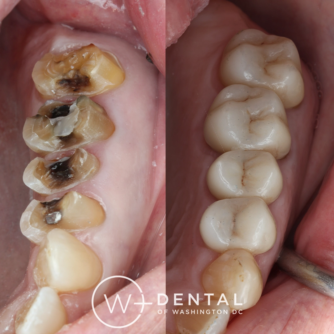 Before and after dental implants at W Plus Dental – patient's smile transformation showing missing teeth replaced with natural-looking implants and custom crowns, Washington DC