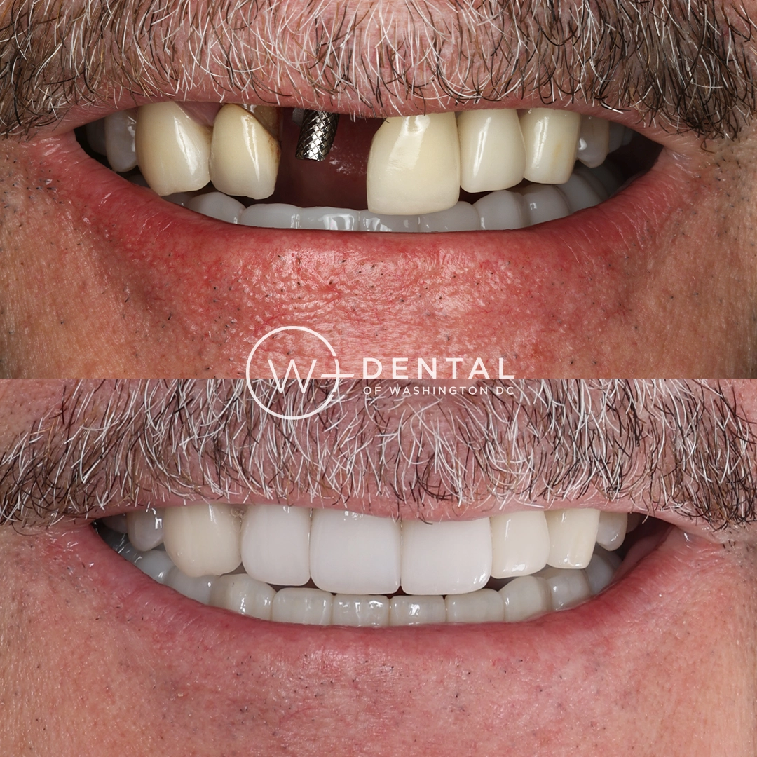 Before and after All-on-X dental implants at W Plus Dental – full arch tooth replacement transforming missing and failing teeth to a complete, permanent smile, Washington DC