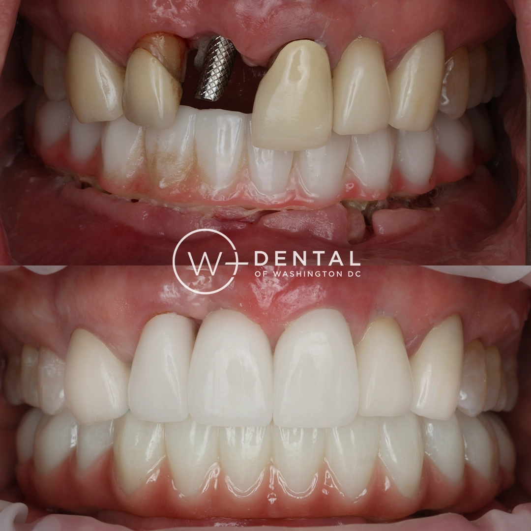 before and after dental bonding for a chipped tooth