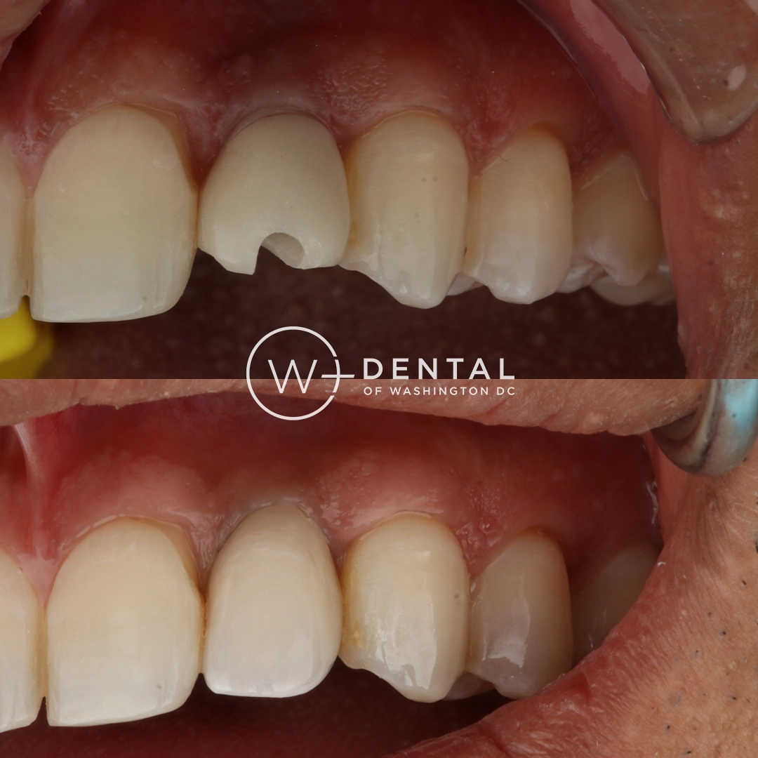 Before and after dental crown at W Plus Dental– cracked and weakened tooth fully restored with a custom porcelain crown for strength and natural appearance, Washington DC