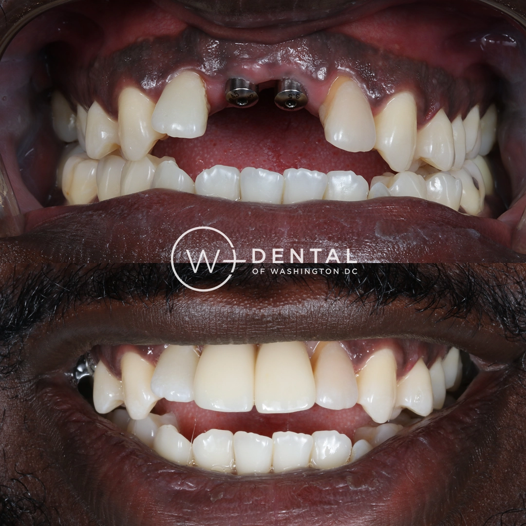 before and after dental bonding for a chipped tooth
