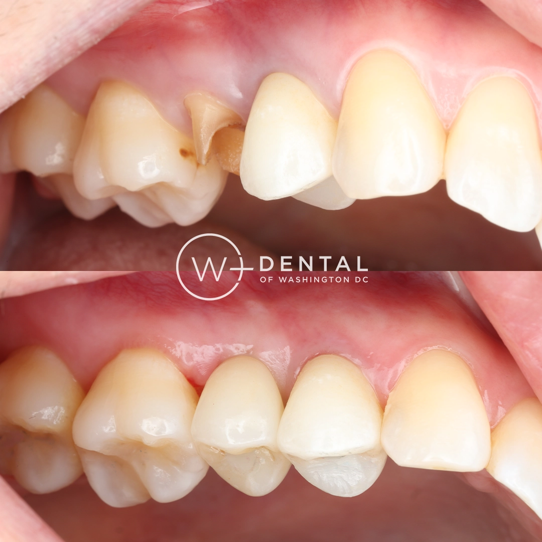 Before and after dental implants at W Plus Dental – patient's smile transformation showing missing teeth replaced with natural-looking implants and custom crowns, Washington DC