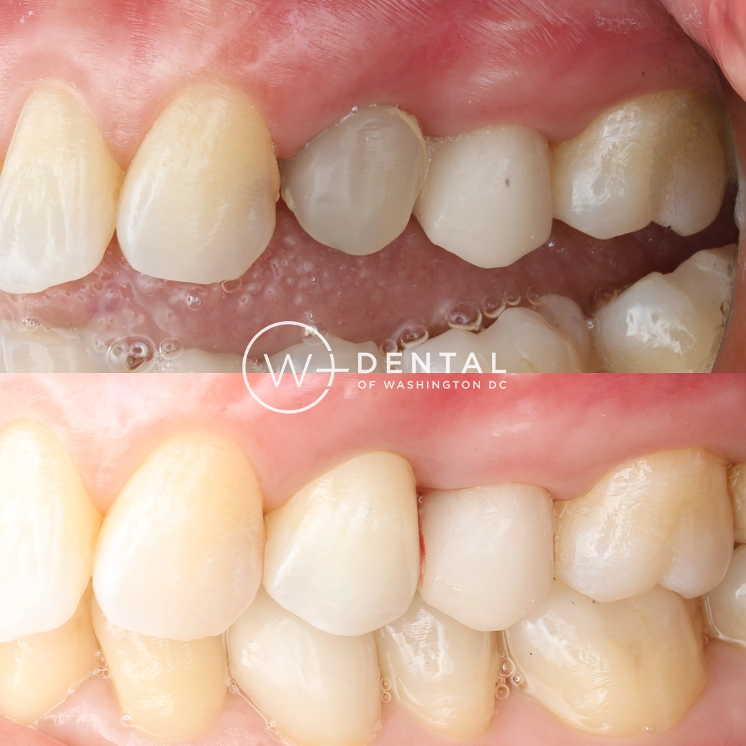 Before and after dental implants at W Plus Dental – patient's smile transformation showing missing tooth replaced with natural-looking implant, Washington DC