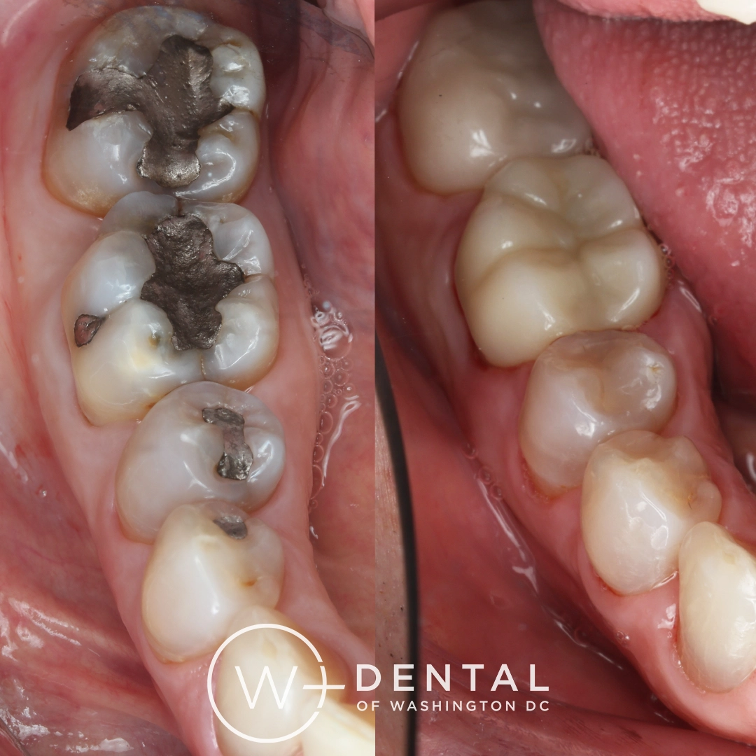 Before and after dental crown at W Plus Dental– replacing old silver fillings with a custom porcelain crown for strength and natural appearance, Washington DC