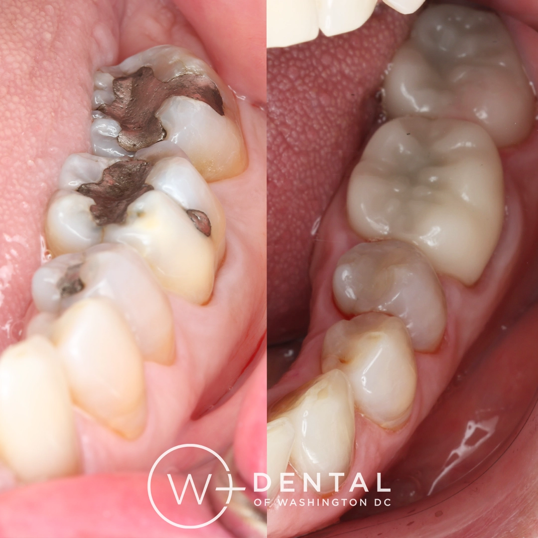 before and after dental bonding for a chipped tooth