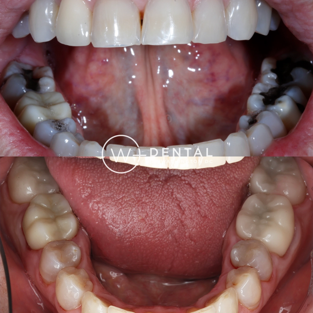 before and after dental bonding for a chipped tooth