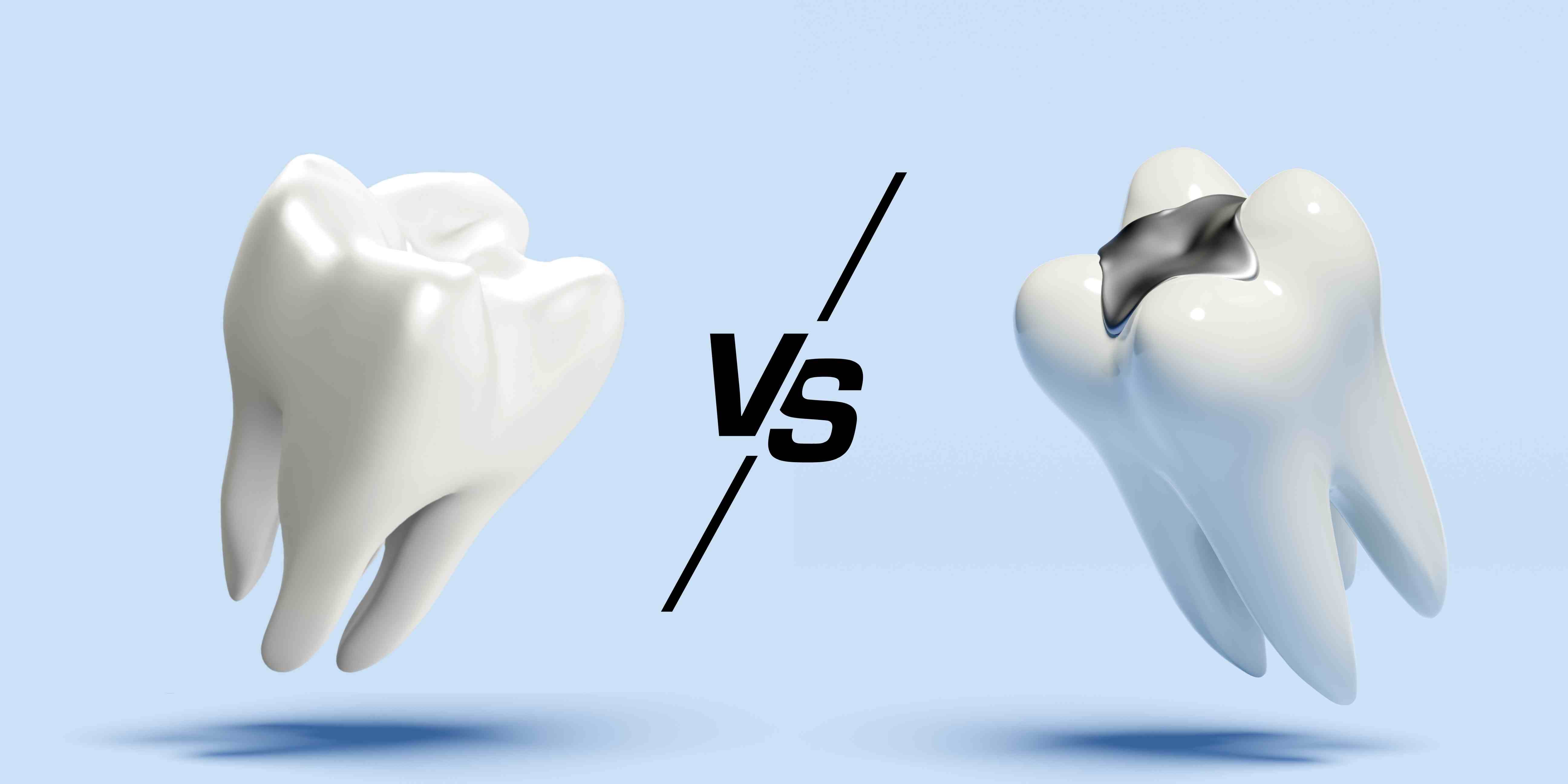 Side-by-side comparison of white composite filling and silver amalgam filling on a tooth model, W Plus Dental Washington DC