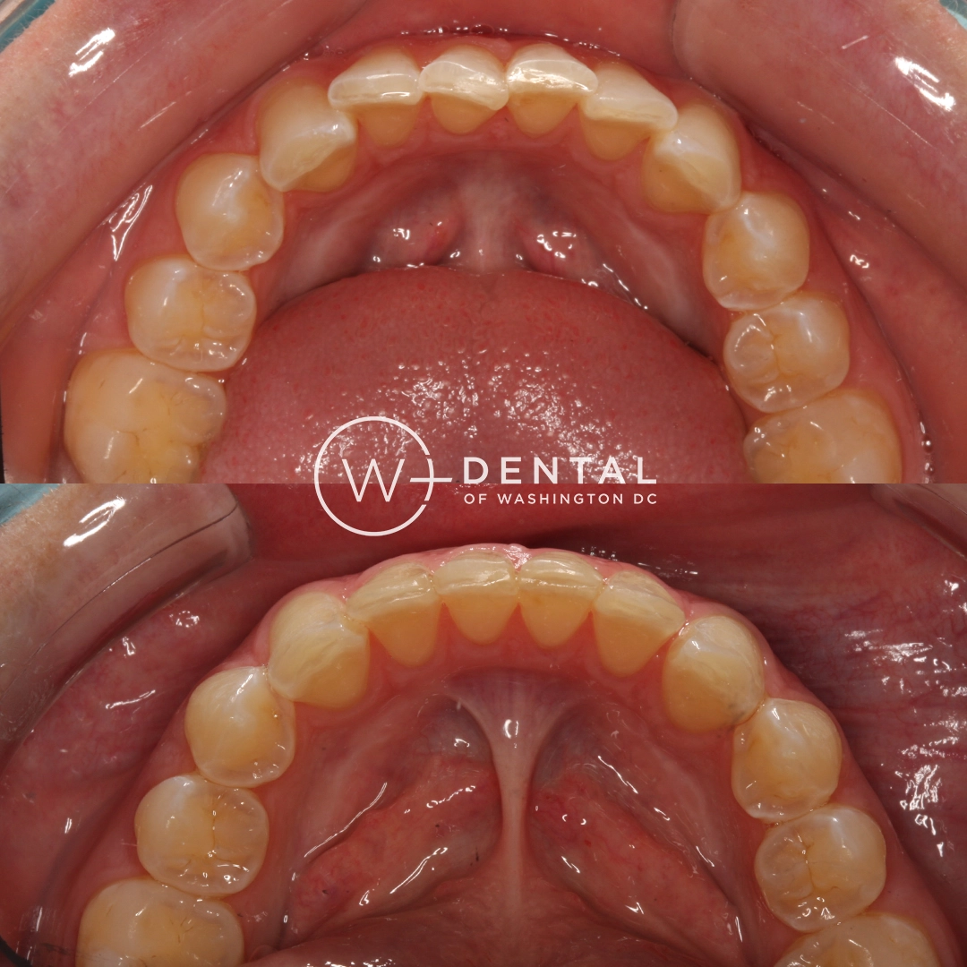 Before and after smile makeover with Invisalign at W Plus Dental – full smile transformation correcting gaps, crooked and uneven teeth, Washington DC
