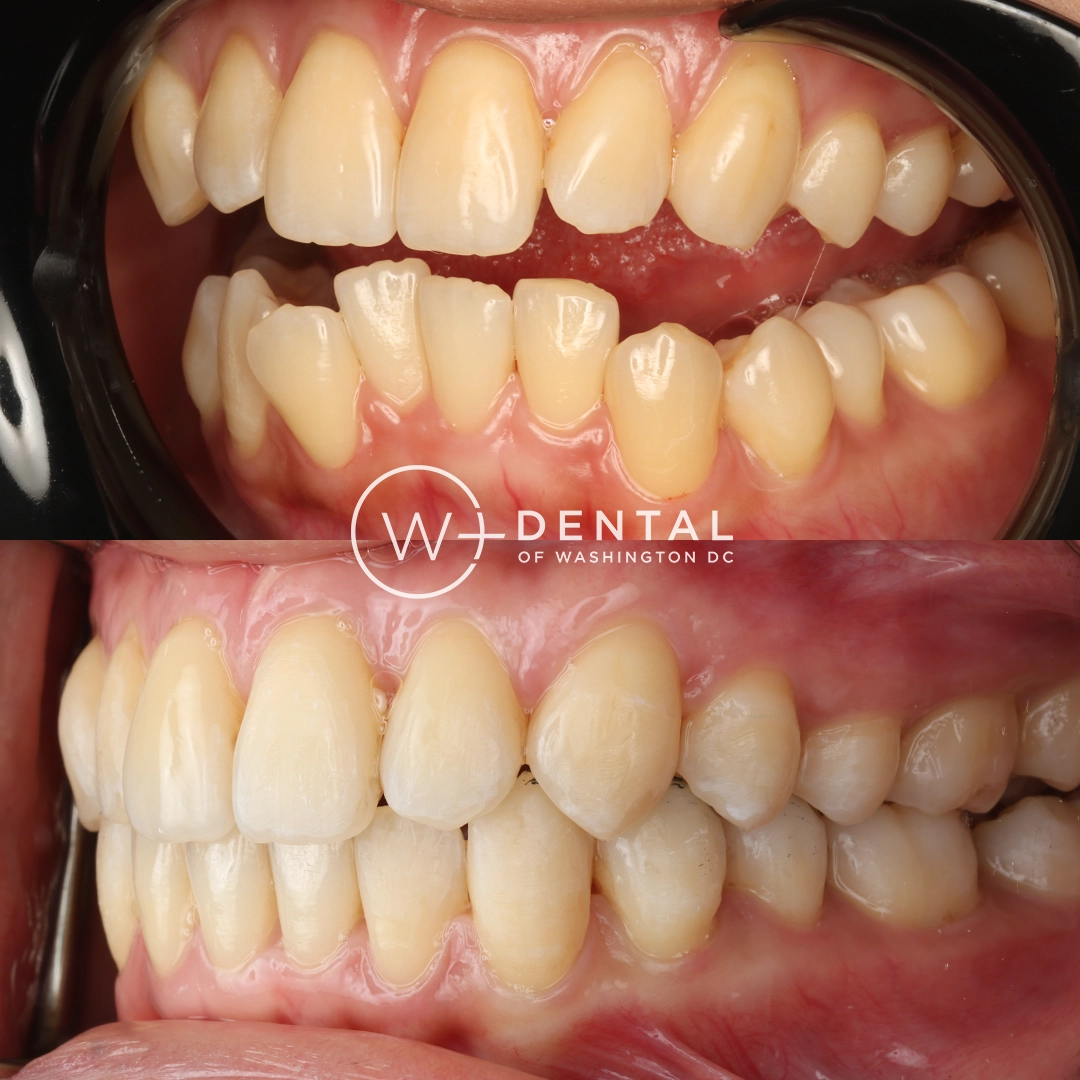 before and after dental bonding for a chipped tooth