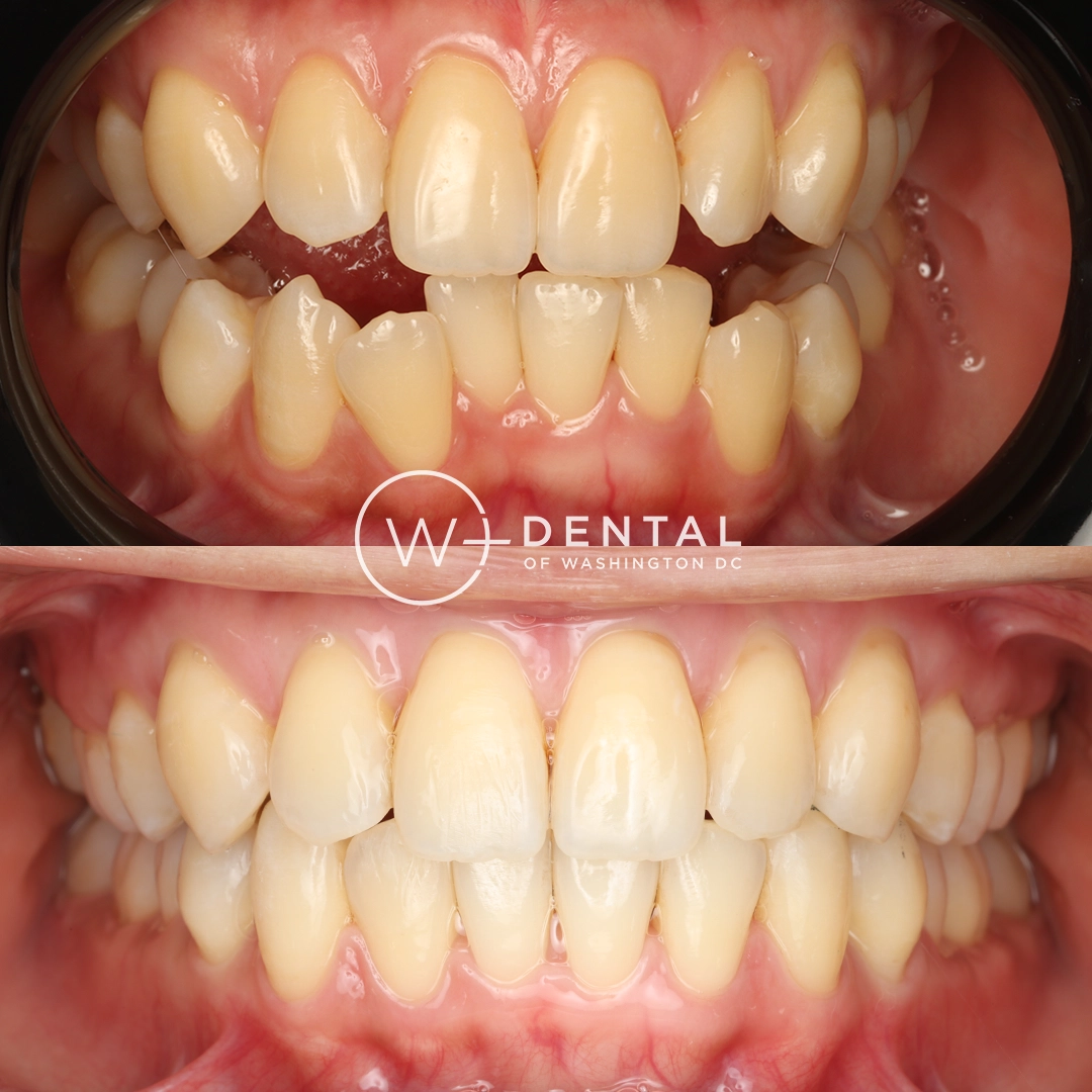 Invisalign before and after showing crowded teeth transformed into a straighter, more aligned smile at W Plus Dental in Washington, DC.
