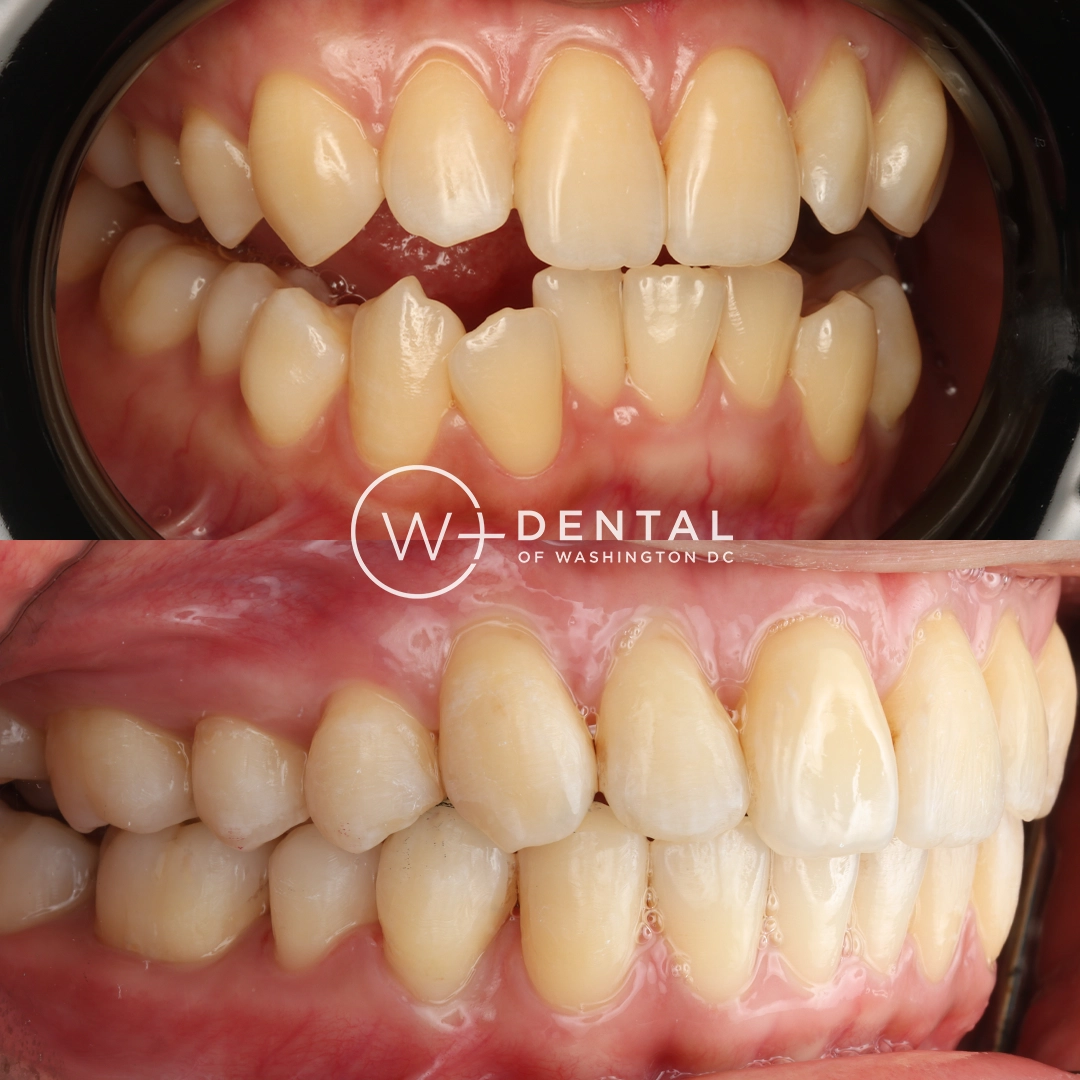 before and after dental bonding for a chipped tooth