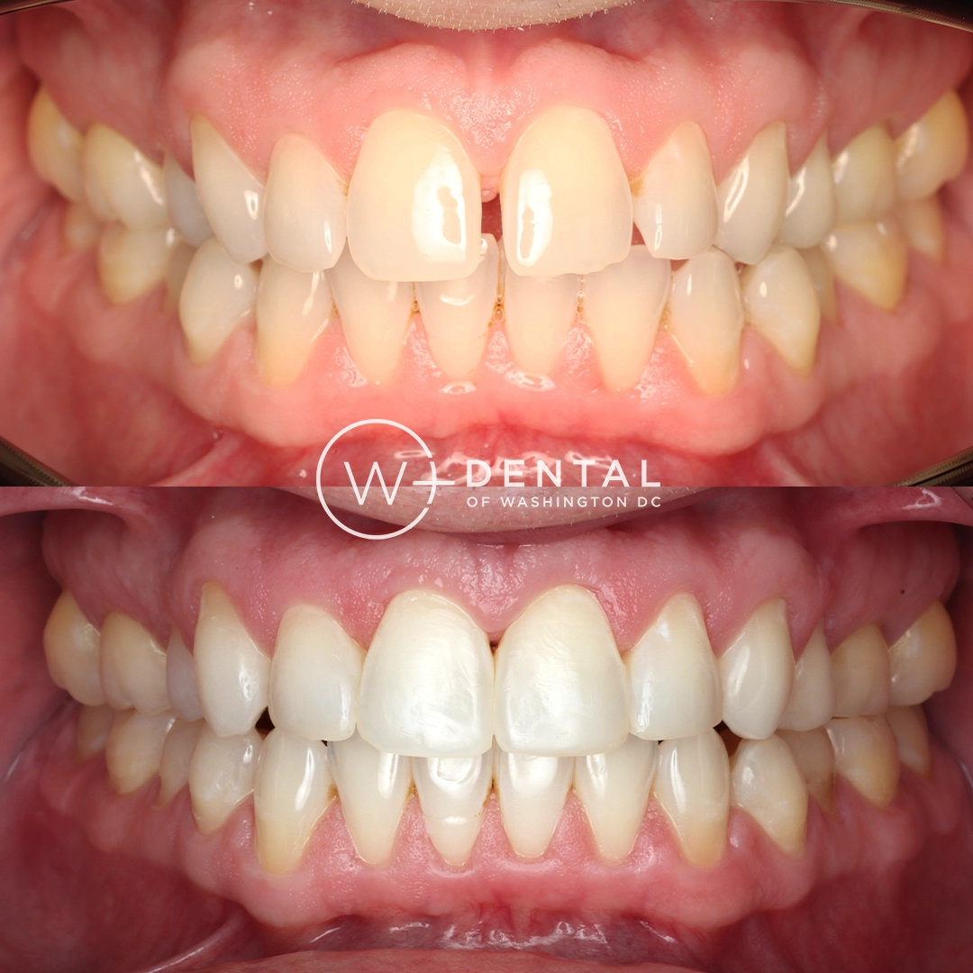 before and after dental bonding for a chipped tooth