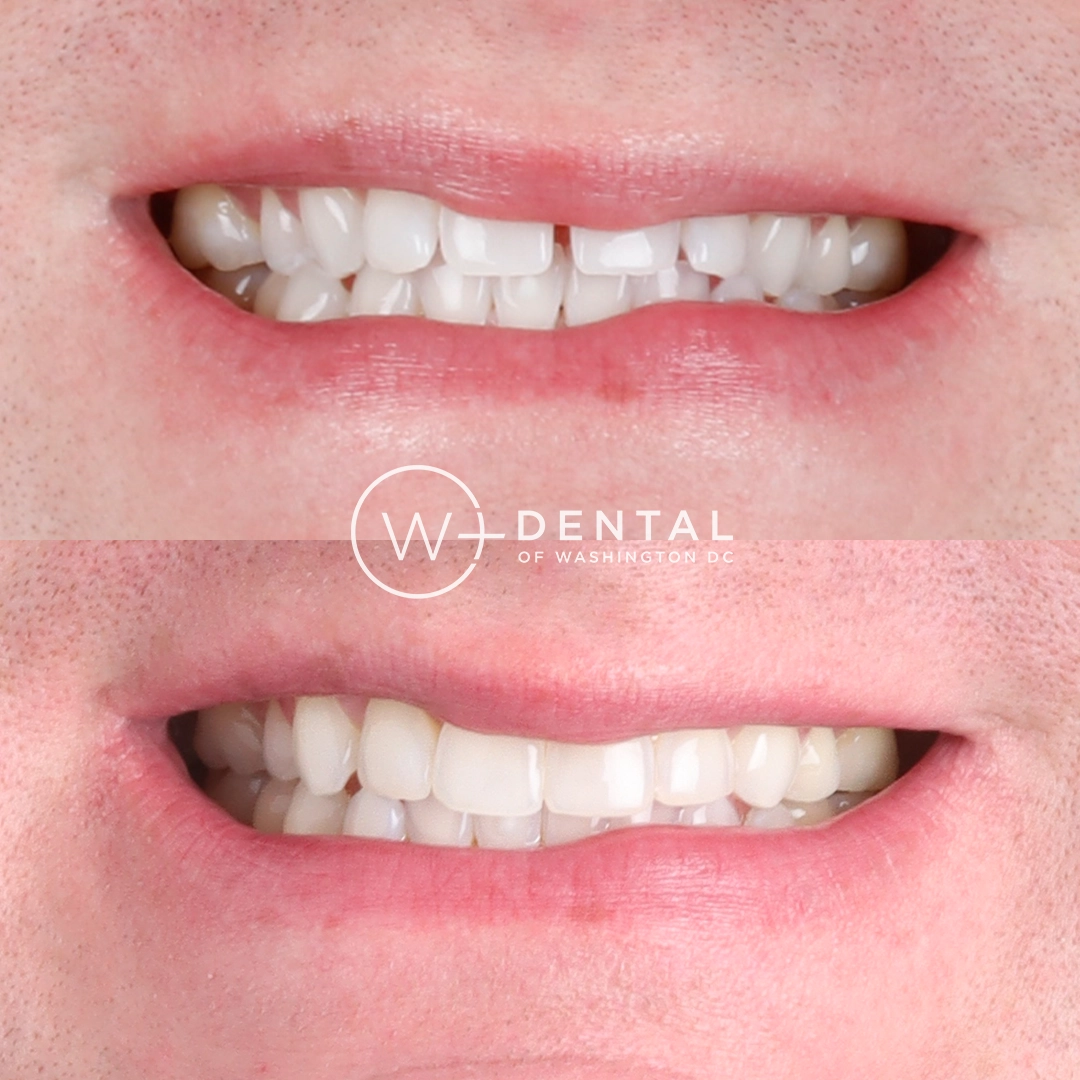 before and after dental bonding for a chipped tooth