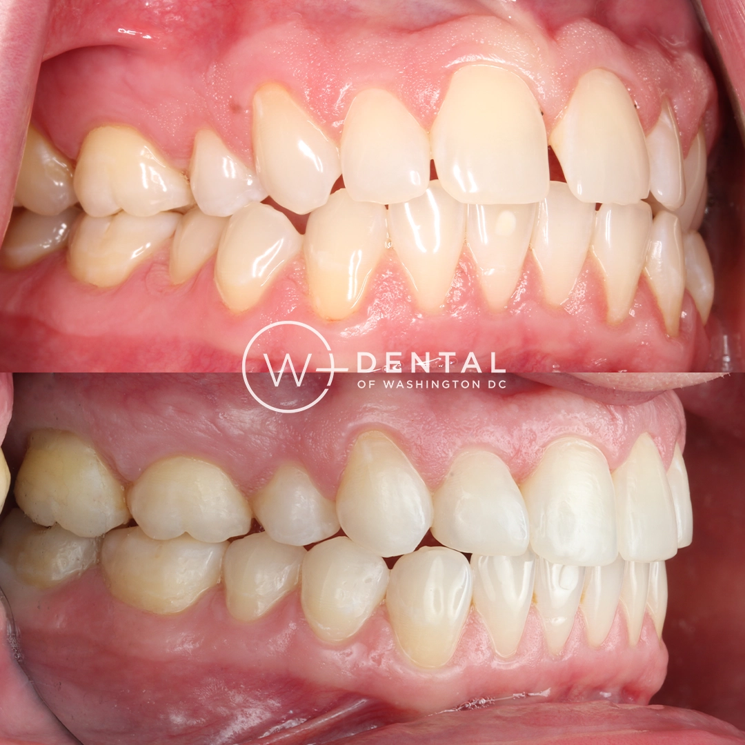 before and after dental bonding for a chipped tooth