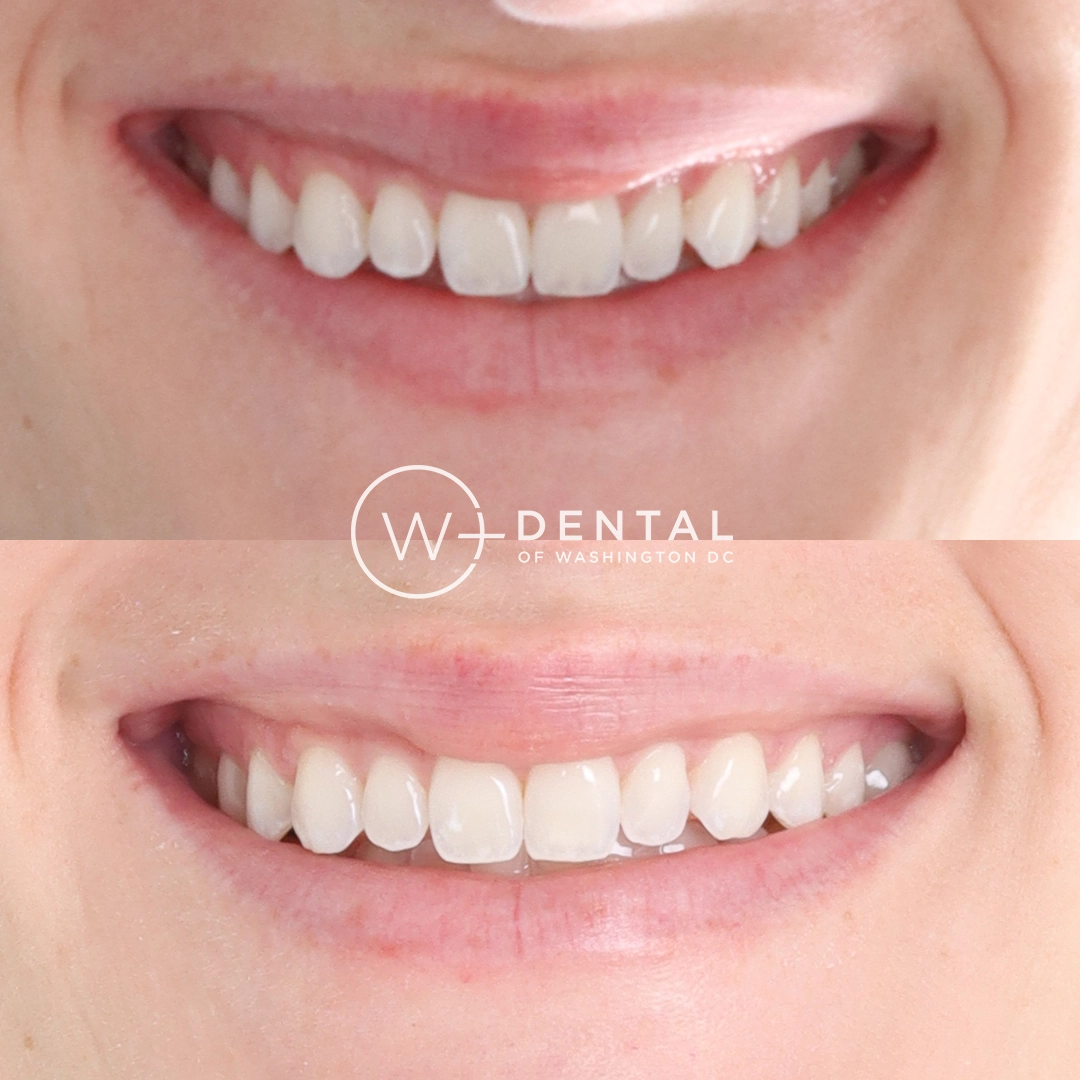 before and after dental bonding for a chipped tooth