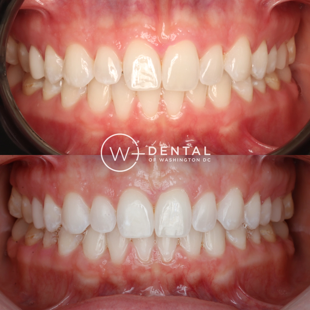 Invisalign before and after showing crowded teeth transformed into a straighter, more aligned smile at W Plus Dental in Washington, DC.