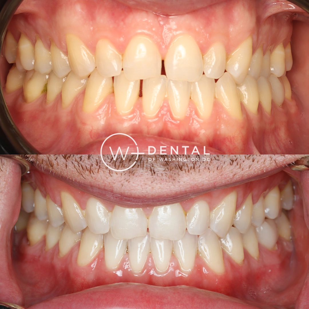 Invisalign before and after showing crowded teeth transformed into a straighter, more aligned smile at W Plus Dental in Washington, DC.