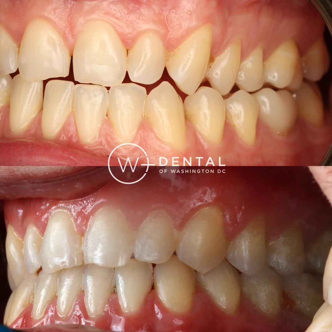 before and after dental bonding for a chipped tooth