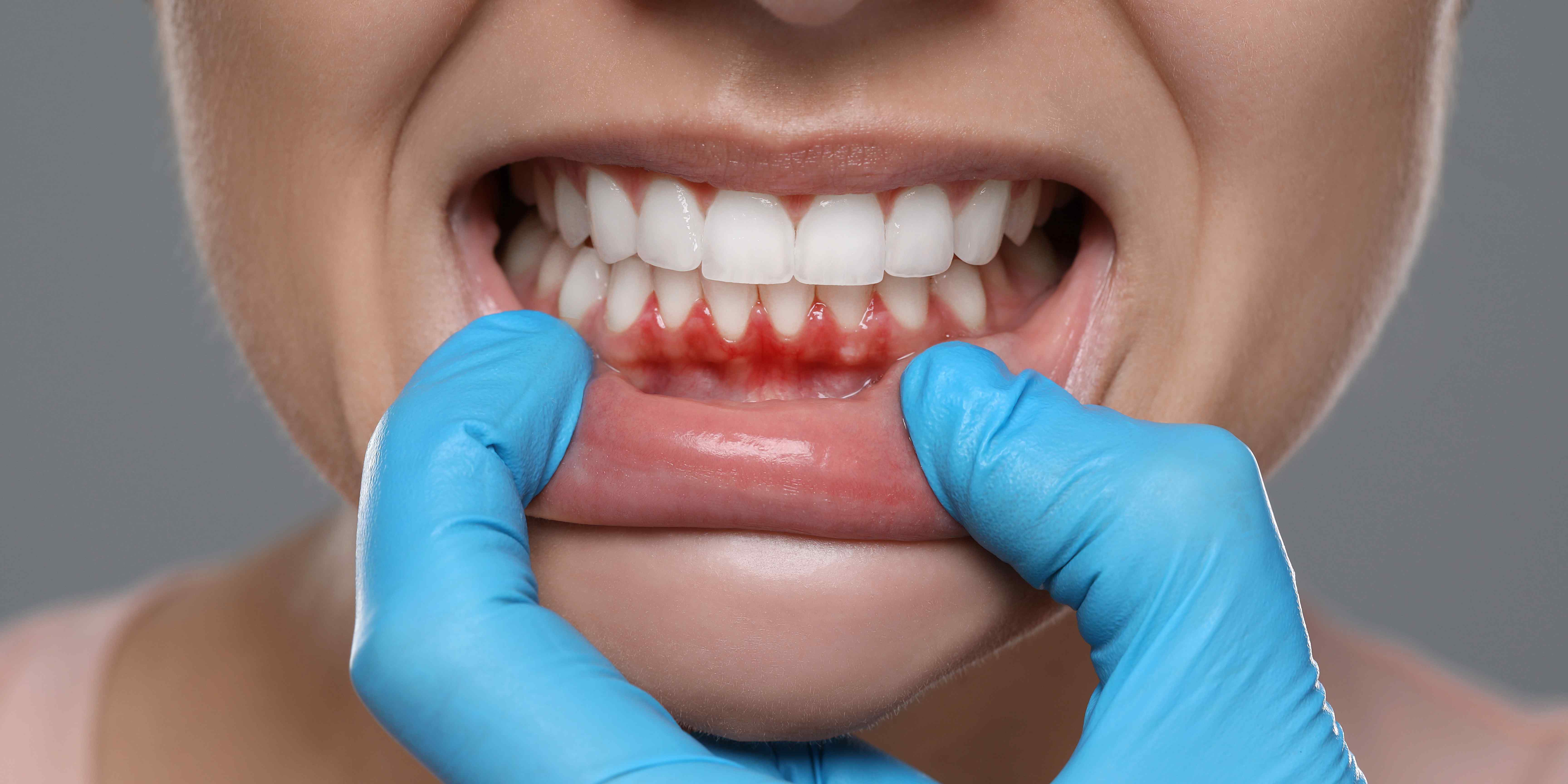 Why are my gums bleeding? Gum disease treatment at W Plus Dental in Washington DC