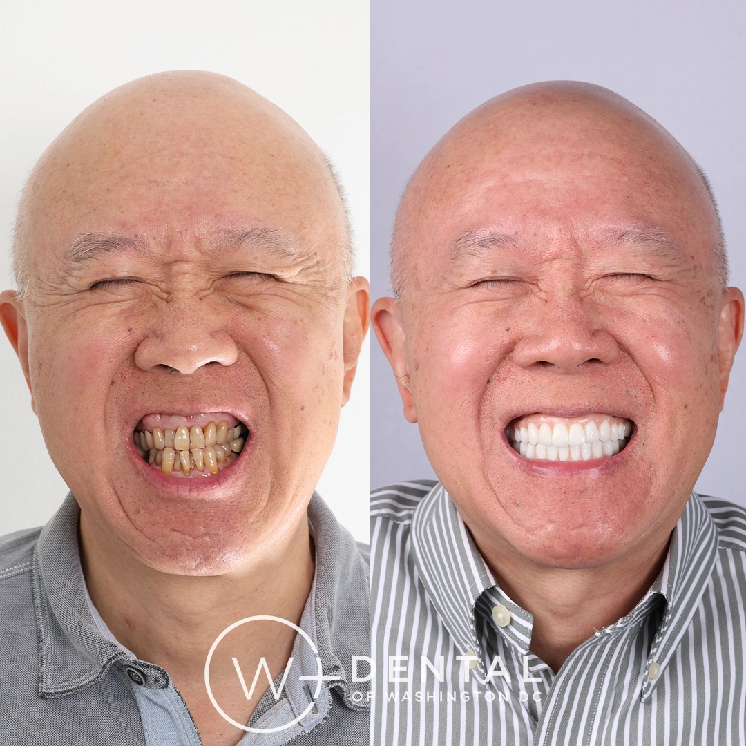 before and after dental bonding for a chipped tooth