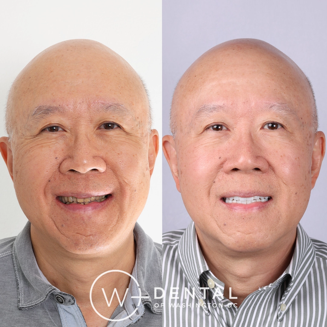 before and after dental bonding for a chipped tooth