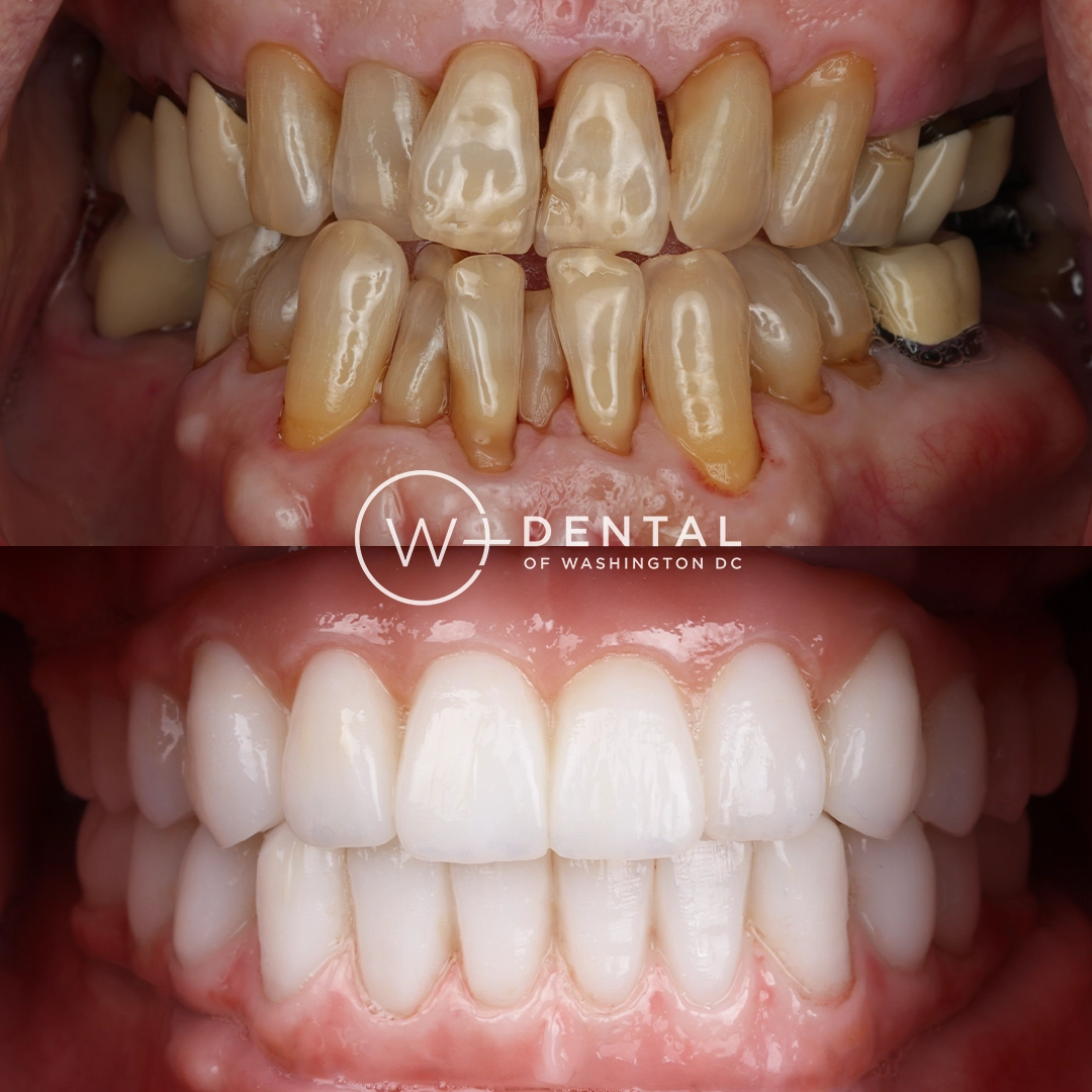 before and after dental bonding for a chipped tooth